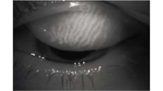 NDOC_Sicca-Das_trockene_Auge